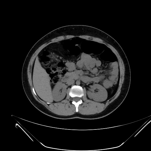 File:Bilateral ovarian mature cystic teratomas (Radiopaedia 79373-92457 Axial non-contrast 19).jpg