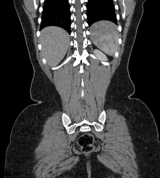 Bilateral ovarian mature cystic teratomas (Radiopaedia 79373-92457 B 91).jpg