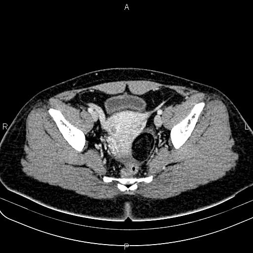 Bilateral ovarian teratoma (Radiopaedia 83131-97503 Axial With contrast 47).jpg