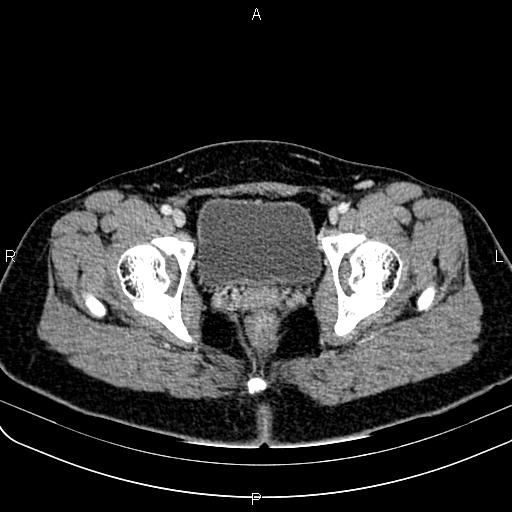 Bilateral ovarian teratoma (Radiopaedia 83131-97503 Axial With contrast 67).jpg