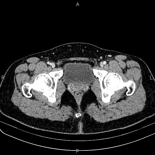 Bilateral ovarian teratoma (Radiopaedia 83131-97503 Axial With contrast 72).jpg