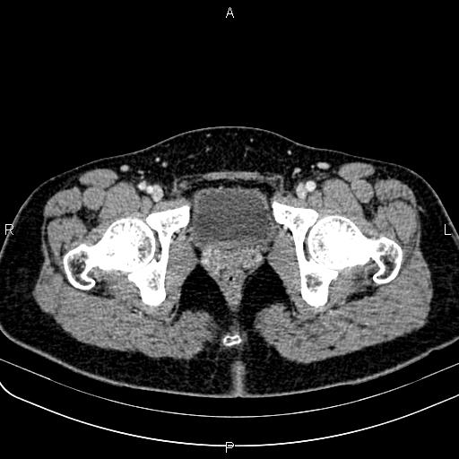 File:Bilateral ovarian teratoma (Radiopaedia 83131-97503 Axial With contrast 73).jpg