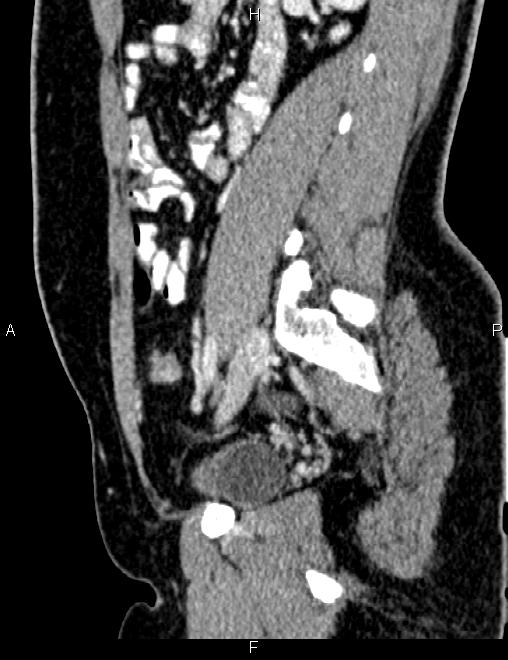 Bilateral ovarian teratoma (Radiopaedia 83131-97503 D 75).jpg
