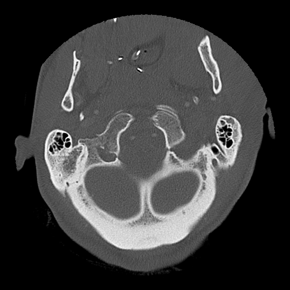 File:Bilateral perched facets with cord injury (Radiopaedia 45587-49713 Axial bone window 20).jpg