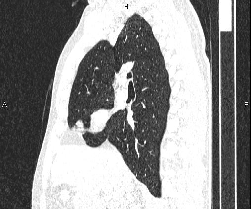 File:Bilateral pulmonary AVM (Radiopaedia 83134-97505 Sagittal lung window 51).jpg