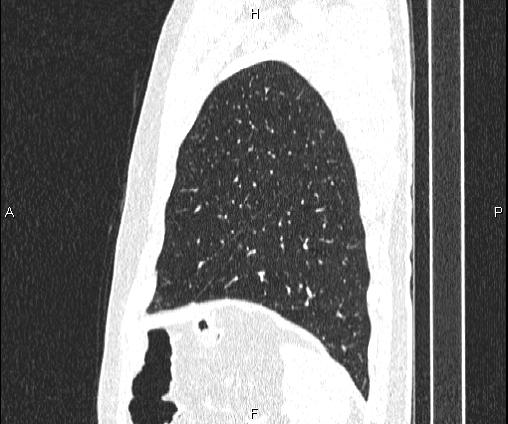 Bilateral pulmonary AVM (Radiopaedia 83134-97505 Sagittal lung window 94).jpg