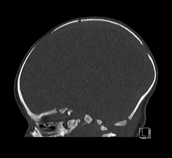 Bilateral subdural hemorrhage and parietal skull fracture (Radiopaedia 26058-26192 Sagittal bone window 57).png