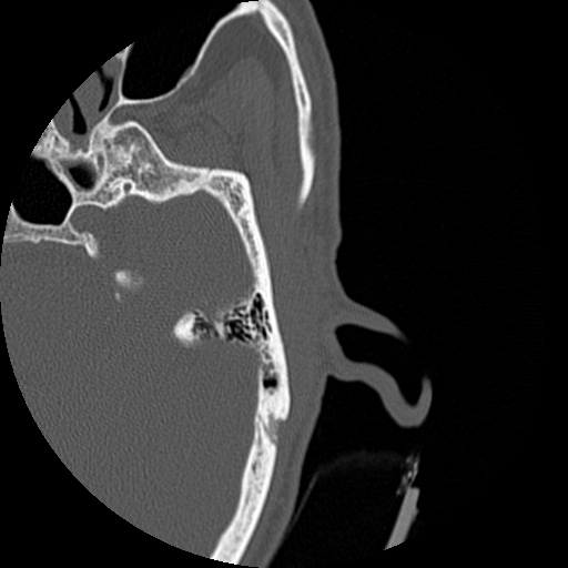 Bilateral temporal bone fractures (Radiopaedia 29482-29970 D 104).jpg