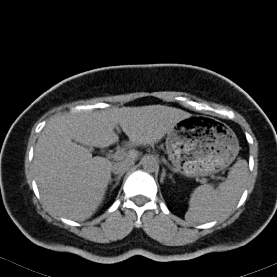 Bilateral ureteric stents (Radiopaedia 48795-53825 Axial non-contrast 12).jpg
