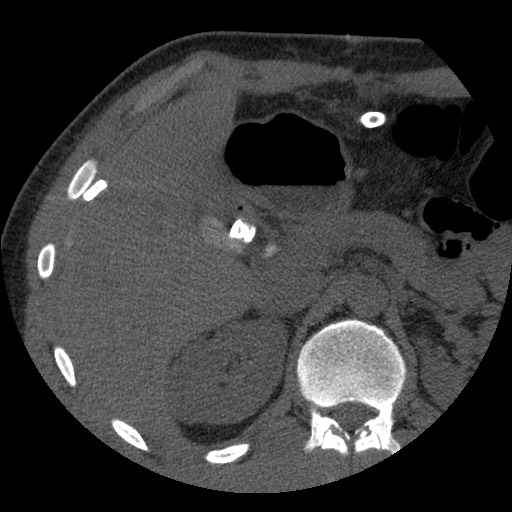 Bile leak from liver traumatic laceration (Radiopaedia 63463-72077 Axial Biliscopin 45).jpg
