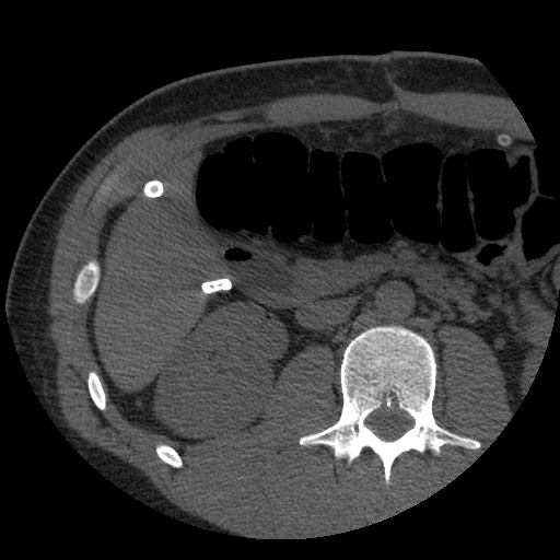 Bile leak from liver traumatic laceration (Radiopaedia 63463-72077 Axial Biliscopin 64).jpg