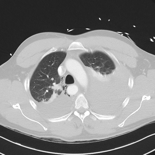 Boerhaave syndrome (Radiopaedia 39382-41661 Axial lung window 16).png