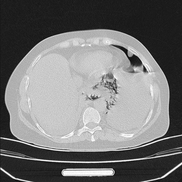 Boerhaave syndrome (Radiopaedia 45644-49799 Axial lung window 90).jpg