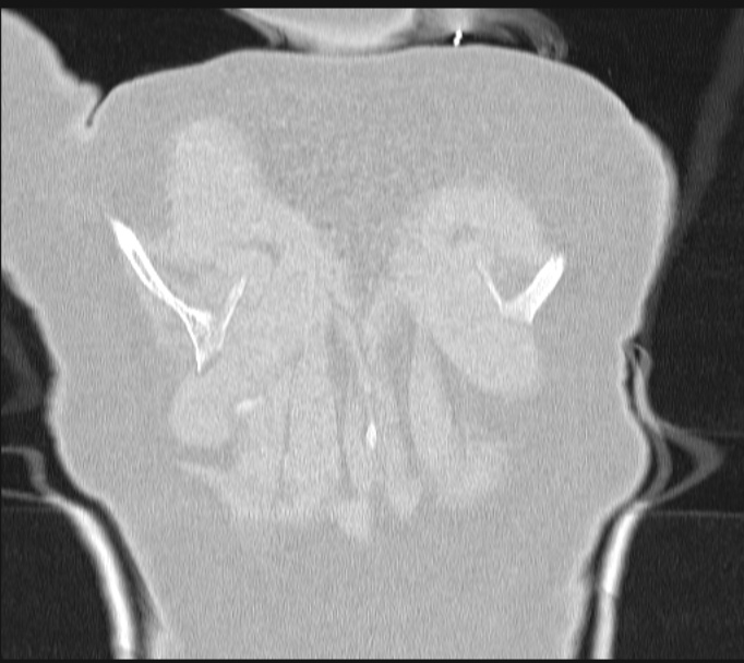 Boerhaave syndrome (Radiopaedia 45644-49799 Coronal lung window 68).jpg