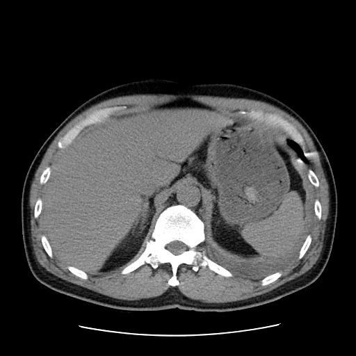 Boerhaave syndrome (Radiopaedia 59796-67310 Axial liver window 60).jpg