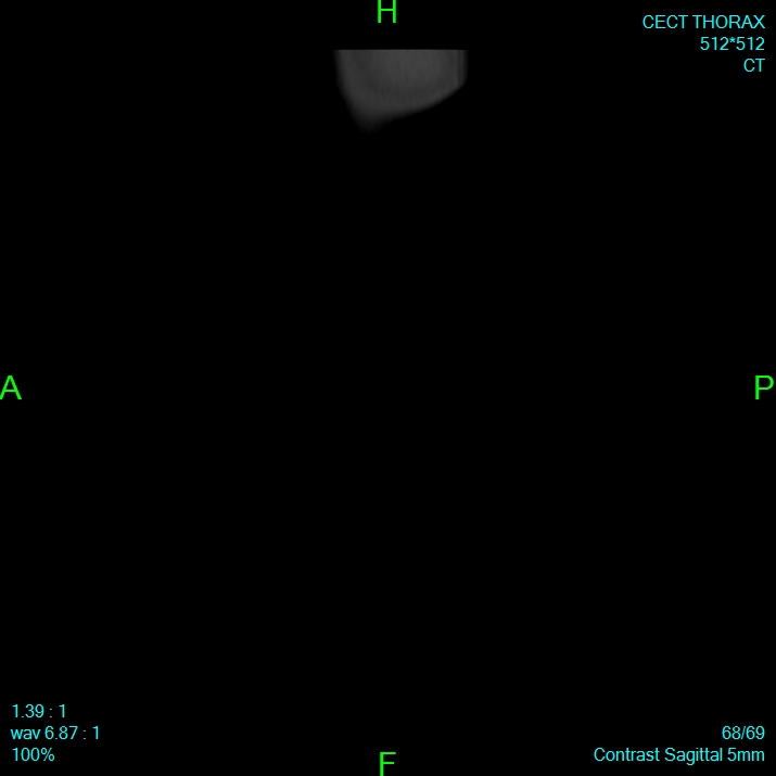 Bone metastases from lung carcinoma (Radiopaedia 54703-60937 Sagittal bone window 68).jpg