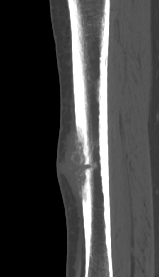 Bone metastasis - tibia (Radiopaedia 57665-64609 Sagittal bone window 85).jpg
