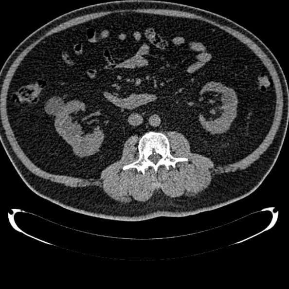 File:Bosniak renal cyst - type IV (Radiopaedia 24244-24518 Axial non-contrast 148).jpg