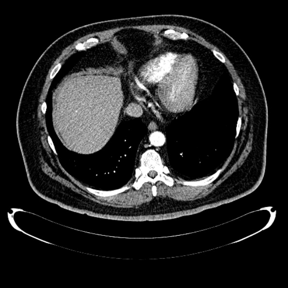 File:Bosniak renal cyst - type IV (Radiopaedia 24244-24518 B 19).jpg