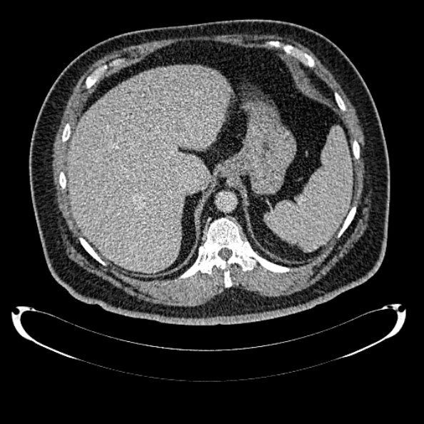 Bosniak renal cyst - type IV (Radiopaedia 24244-24518 C 54).jpg