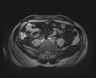 Bouveret syndrome (Radiopaedia 61017-68856 Axial T1 fat sat 71).jpg