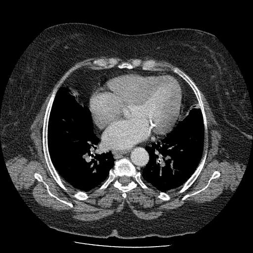 Bovine aortic arch - right internal mammary vein drains into the superior vena cava (Radiopaedia 63296-71875 A 94).jpg