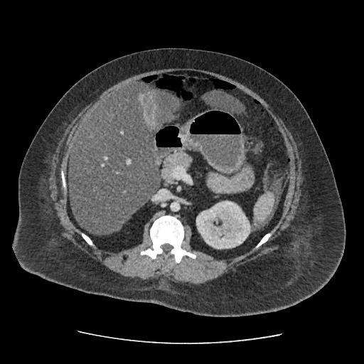 Bowel and splenic infarcts in acute lymphocytic leukemia (Radiopaedia 61055-68915 A 56).jpg