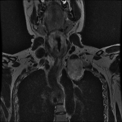 File:Brachial plexus neurofibroma (Radiopaedia 28030-28291 Coronal T2 8).png