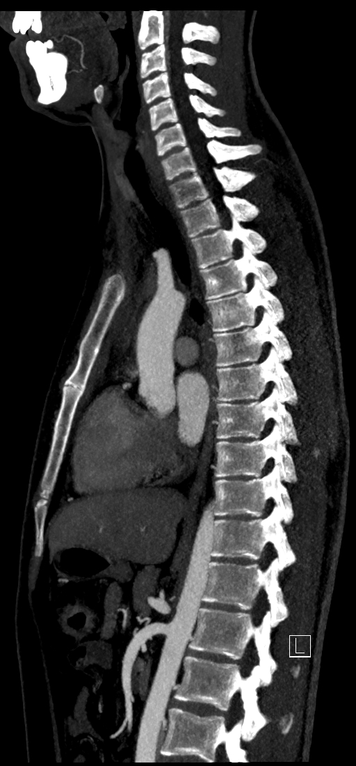 Brachiocephalic trunk pseudoaneurysm (Radiopaedia 70978-81191 C 50).jpg