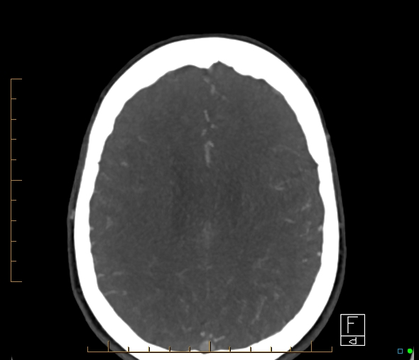 Brachiocephalic trunk stenosis (Radiopaedia 87242-103519 A 22).jpg