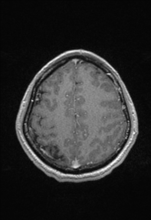 Brain abscess with ventriculitis (Radiopaedia 85703-101495 Axial T1 C+ 135).jpg