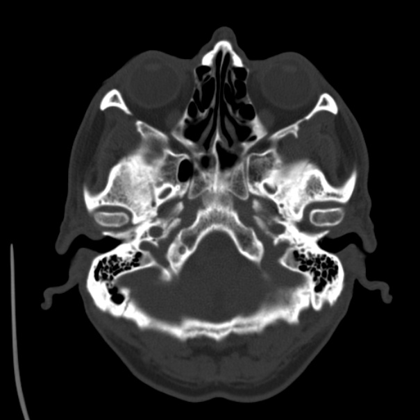 Brain metastases from lung cancer (Radiopaedia 24480-24781 Axial bone window 6).jpg