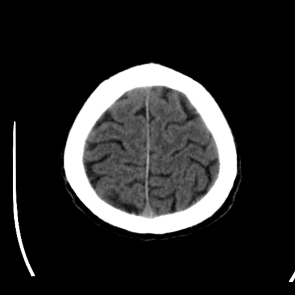 Brain metastases from lung cancer (Radiopaedia 24480-24781 Axial non-contrast 44).jpg