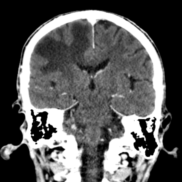 Brain metastases from lung cancer (Radiopaedia 27849-28092 Coronal C+ delayed 37).jpg