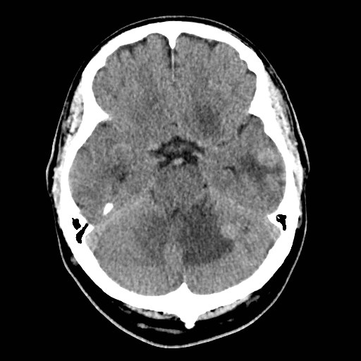File:Brain metastases from lung cancer (Radiopaedia 83839-99027 Axial non-contrast 11).jpg