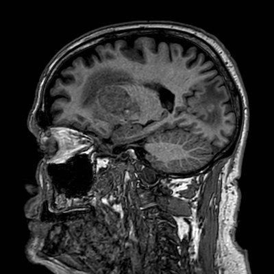 Brain metastases from lung cancer (Radiopaedia 83839-99028 Sagittal T1 46).jpg