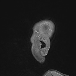 Brain metastasis (Radiopaedia 42617-45761 Sagittal T1 C+ 2).jpg