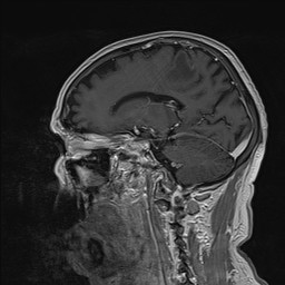 Brain metastasis (Radiopaedia 42617-45761 Sagittal T1 C+ 40).jpg