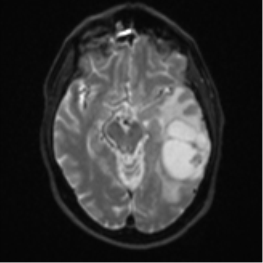 Brain metastasis (large cystic mass) (Radiopaedia 47497-52107 Axial DWI 11).png