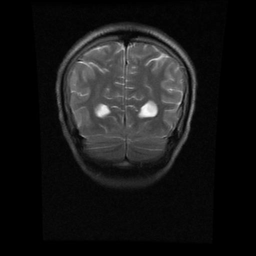 File:Brainstem glioma (Radiopaedia 30923-31624 Coronal T2 3).jpg