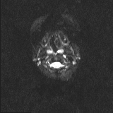 Brainstem glioma (Radiopaedia 67531-76922 Axial DWI 2).jpg
