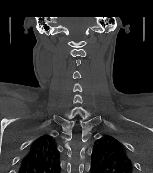 File:Branchial cleft cyst (Radiopaedia 31167-31875 Coronal bone window 47).jpg