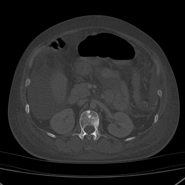 Breast cancer metastases - hepatic and skeletal (Radiopaedia 34201-35461 Axial bone window 54).jpg