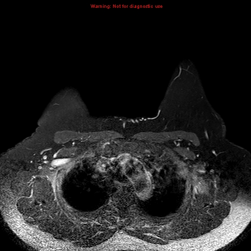 File:Breast carcinoma (multicentric multifocal in mammary Paget disease) (Radiopaedia 50966-56512 Axial T1 C+ fat sat 13).jpg