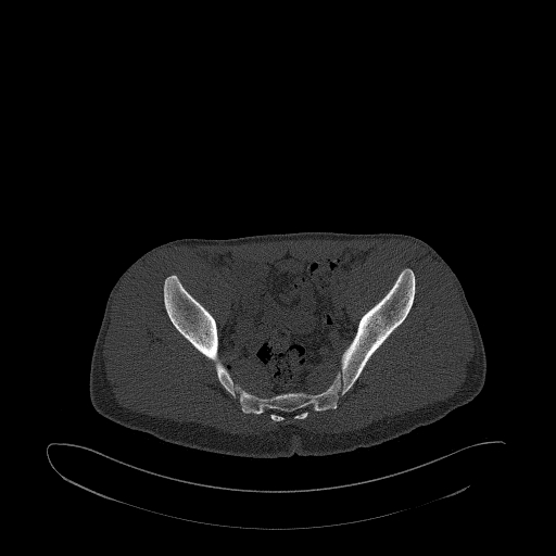 Brodie abscess- femoral neck (Radiopaedia 53862-59966 Axial bone window 91).jpg
