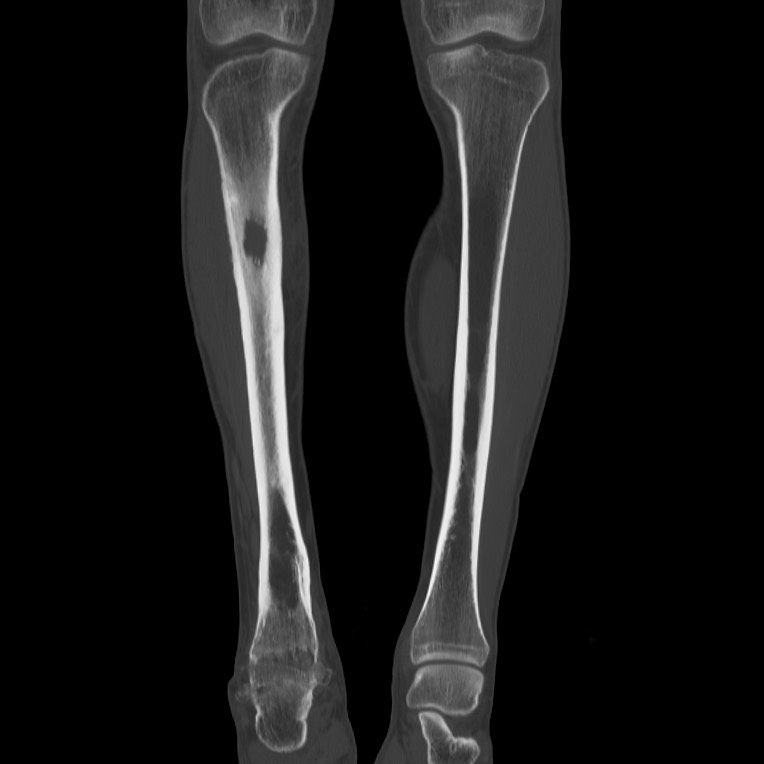 Brodie abscess - tibia (Radiopaedia 66028-75204 Coronal bone window 17).jpg