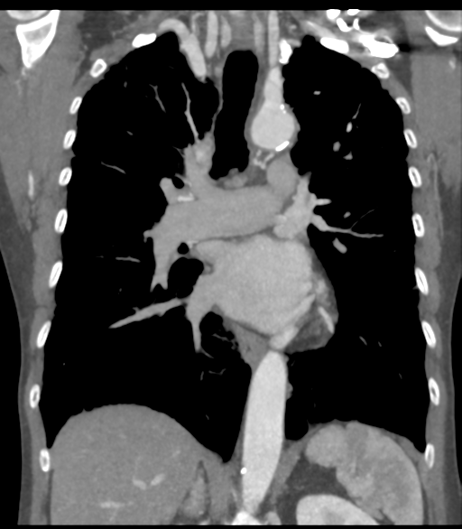 File:Bronchial artery aneurysms (Radiopaedia 42282-45385 Coronal C+ delayed 36).png