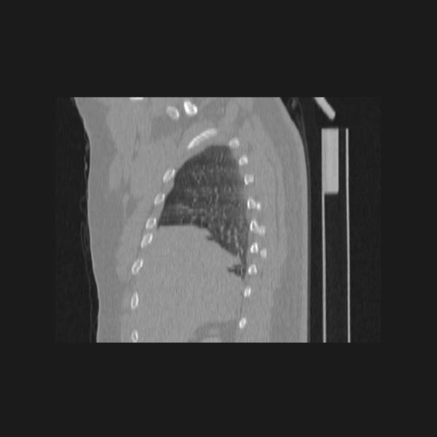 Bronchial atresia (Radiopaedia 60685-68439 Sagittal lung window 13).jpg