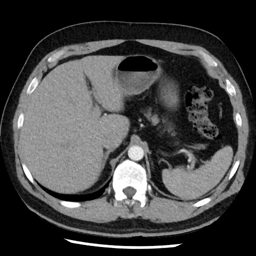 Bronchial carcinoid tumor (Radiopaedia 67377-76764 A 59).jpg