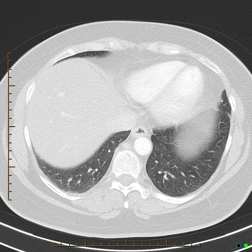 Bronchial diverticula (Radiopaedia 79512-92675 Axial lung window 38).jpg